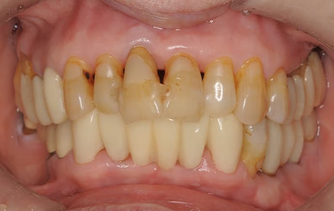 重度歯周病の歯を可能な限り保存した症例